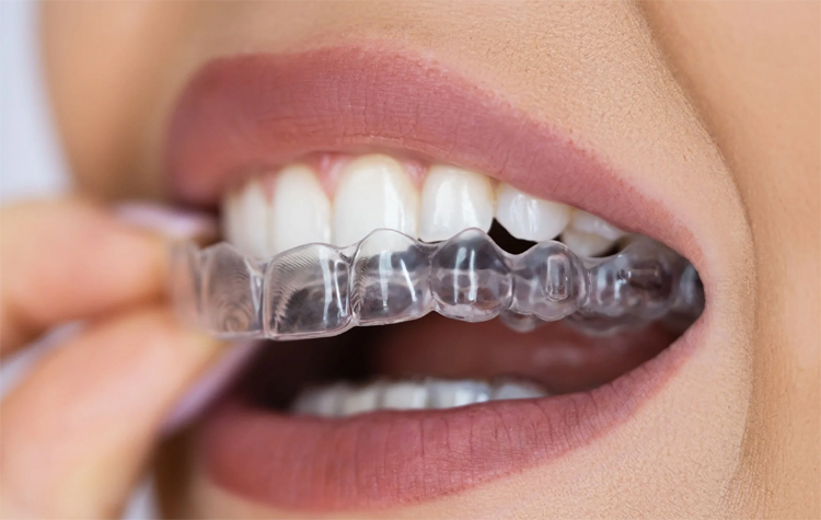 Şeffaf Aparey (İnvisalign)